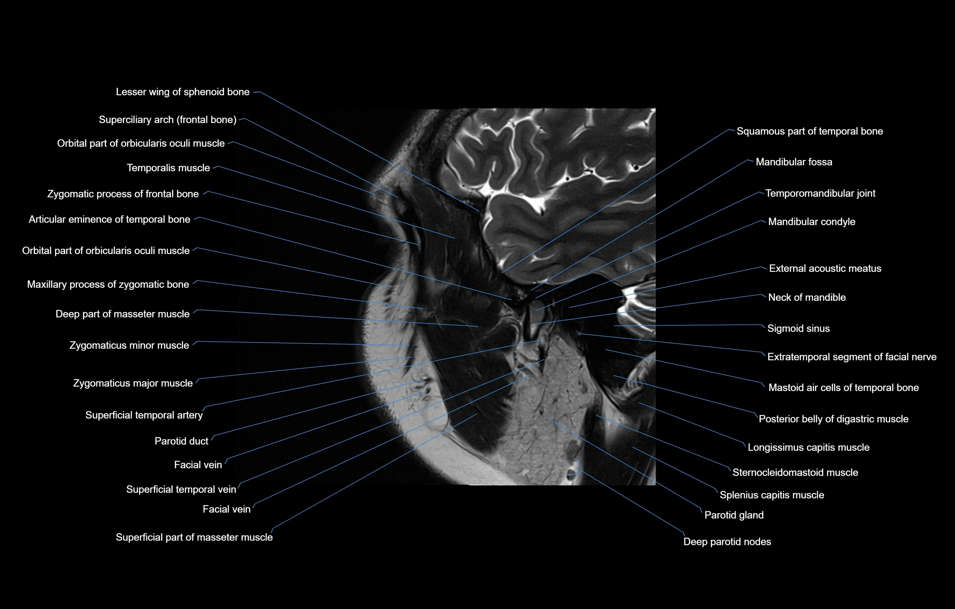 paranasal sinuses(PNS) MRI coronal  cross sectional anatomy 3T radiology  image-img-00001-00020.webp